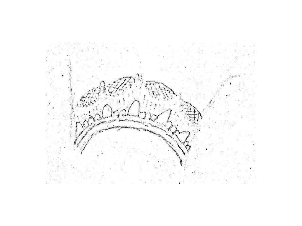 diadem-patitis